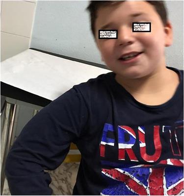 Intronic Variant in CNTNAP2 Gene in a Boy With Remarkable Conduct Disorder, Minor Facial Features, Mild Intellectual Disability, and Seizures